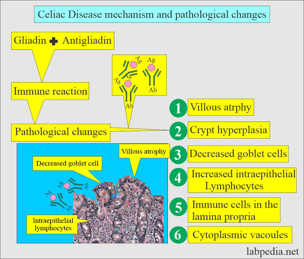 Anti-gliadin antibodies (AGA) are autoantibodies that target gliadin, a component of gluten found in wheat and related grains.