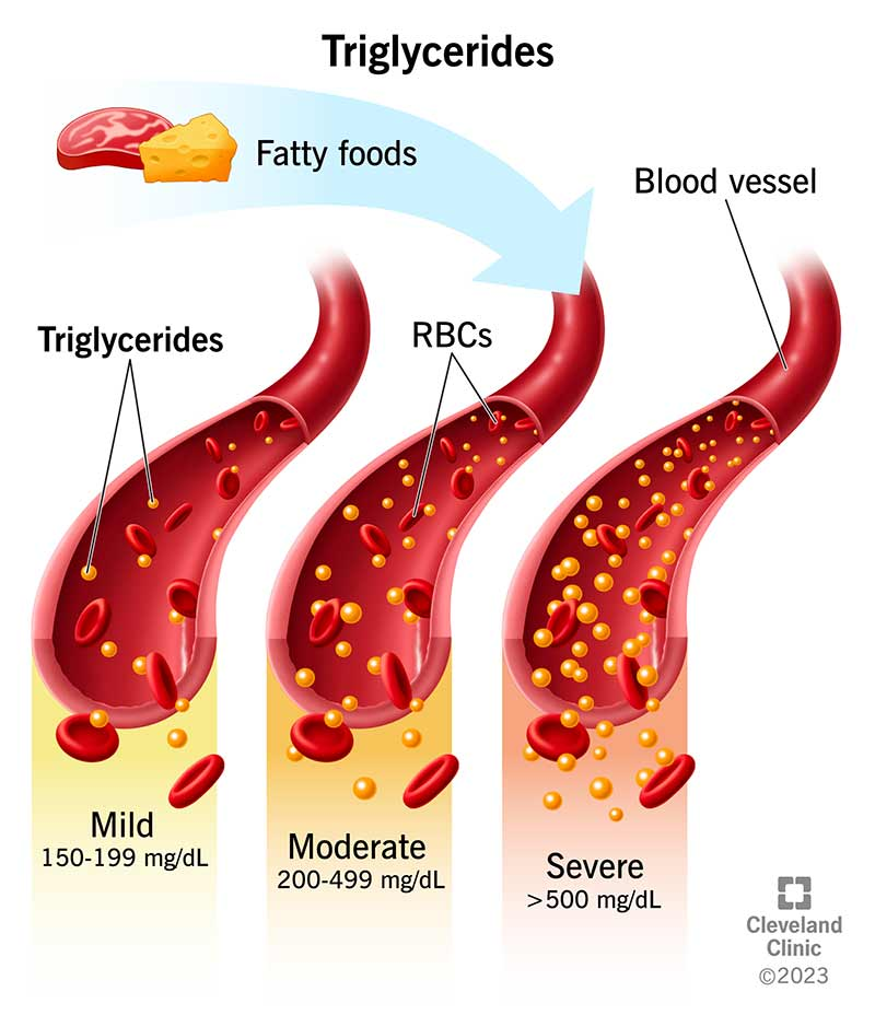 Triglycerides are a type of lipid composed of three fatty acid molecules esterified to a glycerol backbone.