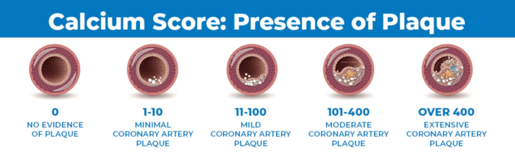 Coronary Calcium Scoring (CCS), also known as Coronary Artery Calcium (CAC) scoring, is a non-invasive imaging test that quantifies the amount of calcified plaque in the coronary arteries.