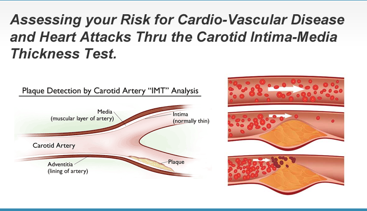 Carotid Intima-Media Thickness (CIMT) is a non-invasive ultrasound test that measures the thickness of the two innermost layers of the carotid artery walls: the intima and media. 