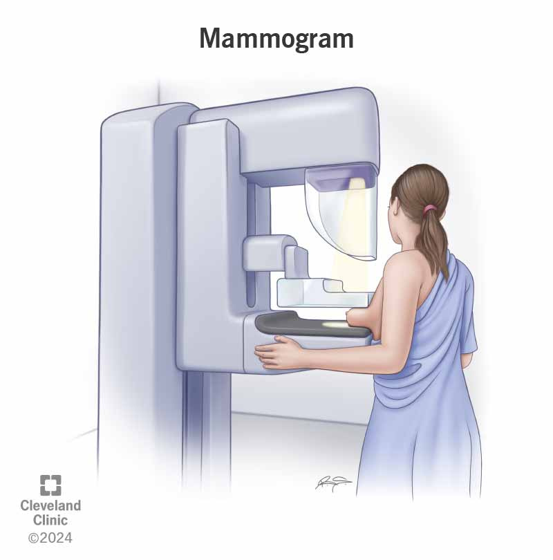 A mammogram (MG) is a specialized X-ray examination of the breast used primarily for the early detection and diagnosis of breast diseases, particularly breast cancer. 