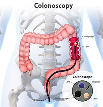 A colonoscopy is a medical procedure that allows a healthcare provider to examine the inner lining of the large intestine (colon) and rectum using a flexible tube called a colonoscope. 