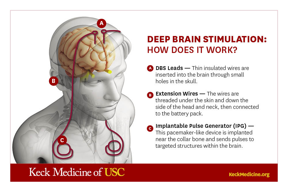 Deep Brain Stimulation (DBS) is a neurosurgical procedure that involves implanting electrodes in specific areas of the brain to deliver electrical impulses.