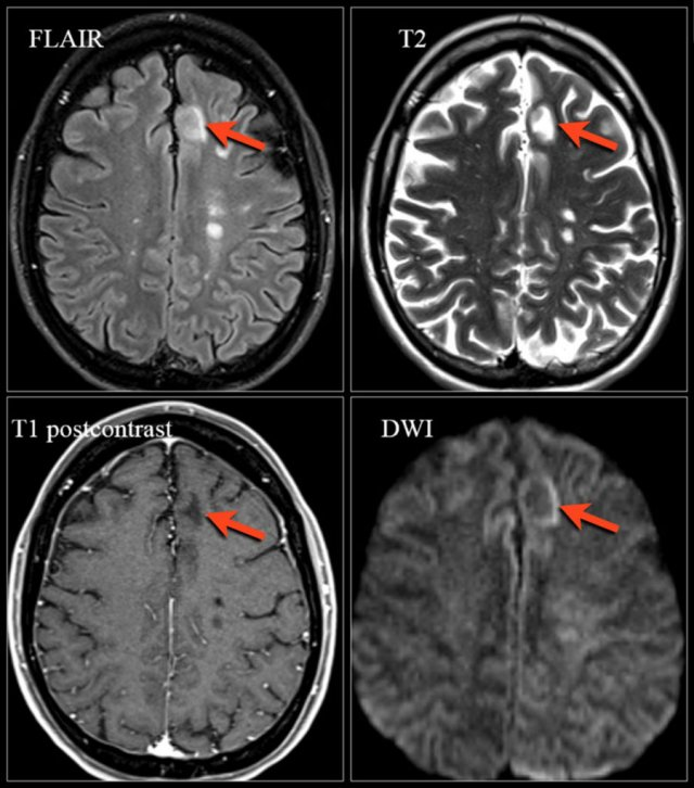 MRI Report Example of Multiple Sclerosis (MS)

Clinical Indication: History of recurrent neurological symptoms; suspect multiple sclerosis.

Findings:

Multiple hyperintense lesions on T2 and FLAIR sequences in the periventricular, juxtacortical, and infratentorial regions.

Gadolinium-enhanced T1 images reveal three enhancing lesions in the right parietal and cerebellar regions, indicating active disease.

Spinal cord imaging shows a hyperintense lesion at C2-C3 without enhancement.

Impression: Findings are consistent with multiple sclerosis as per McDonald Criteria.