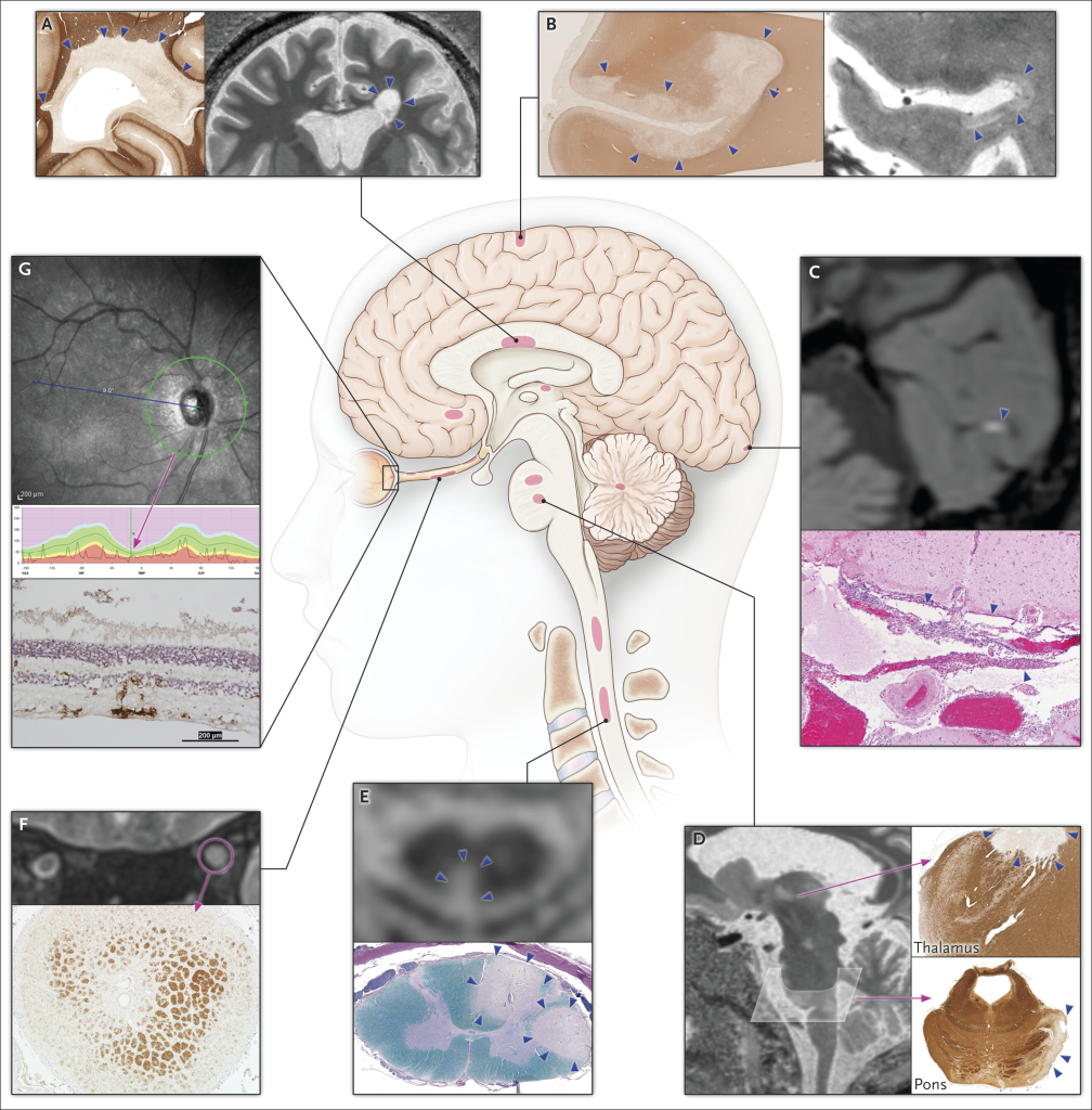 Biopsy Report Example of Multiple Sclerosis (MS)

Specimen: Brain tissue sample from periventricular white matter.

Microscopic Description:

Loss of myelin staining in affected areas with preservation of axons.

Perivascular infiltrates composed of CD4+ and CD8+ T-cells with occasional macrophages.

Reactive astrocytosis observed.

No evidence of neoplasia or infectious organisms.

Diagnosis: Chronic demyelination consistent with a diagnosis of multiple sclerosis[129-133].