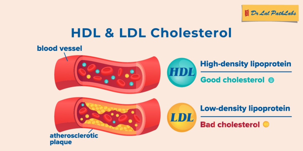 Low-Density Lipoprotein (LDL) cholesterol is often referred to as "bad" cholesterol due to its association with an increased risk of cardiovascular diseases. 