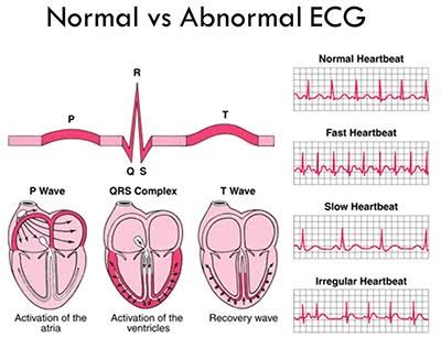 An electrocardiogram (ECG or EKG) is a quick, non-invasive test that records the electrical activity of the heart.