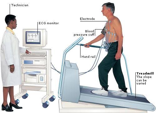 An exercise stress test (EST), also known as a treadmill test or exercise electrocardiogram, evaluates how well the heart functions during physical exertion. 