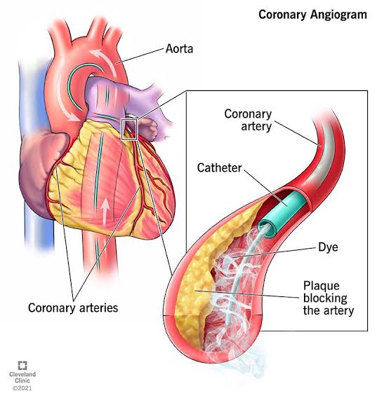 A coronary angiogram is a diagnostic procedure that uses X-ray imaging and a contrast dye to visualize the blood vessels of the heart. 