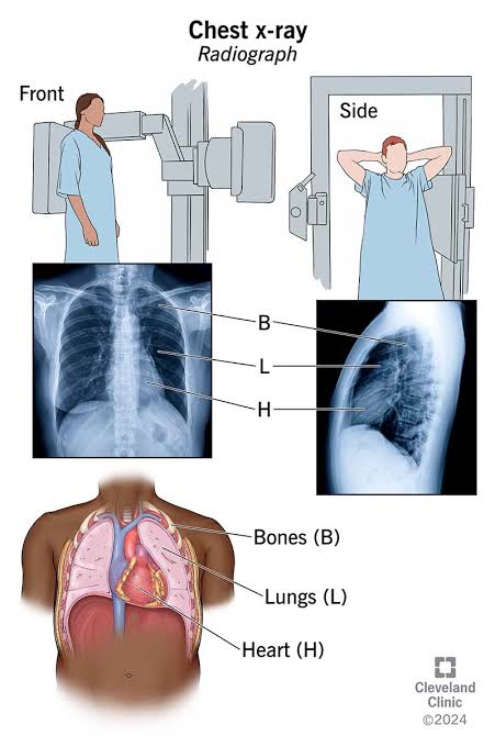 A chest X-ray (CXR) is a common diagnostic imaging technique that uses a small dose of ionizing radiation to create images of the heart, lungs, airways, blood vessels, and bones in the chest.