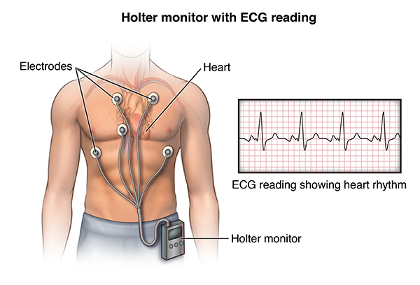 A Holter monitor is a portable, battery-operated device used to continuously record the heart's electrical activity