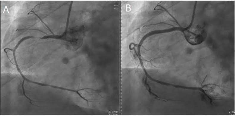 Pre and Post PCI of one of our International Patient’s Improved Circulation Outcomes 6 months after our Cellular Therapy and Stem Cells for CAD/ACS at Right Coronary Artery  