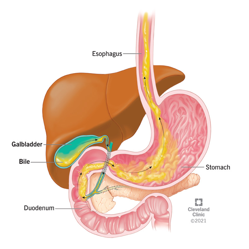 Bile is a digestive fluid produced by the liver and stored in the gallbladder. It plays a crucial role in the digestion and absorption of fats and fat-soluble vitamins in the small intestine.