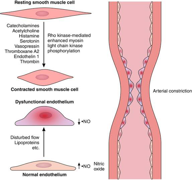 Cells Damaged in Patients with Acute Coronary Syndrome (ACS) and Coronary Artery Disease (CAD) 