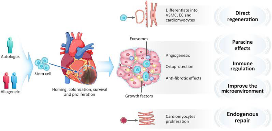 Key Reasons for Our Preference for Cellular Therapy and Stem Cells for CAD/ACS