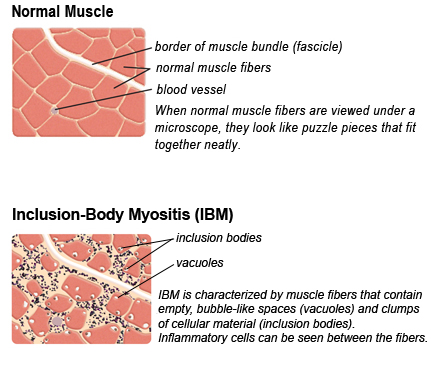 Dr. Griggs' work contributed to the recognition of IBM as a separate entity from other forms of myositis, based on distinct clinical and pathological features observed in affected individuals.