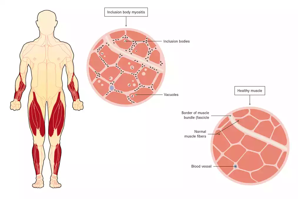 Patients with Inclusion Body Myositis (IBM) stand to gain several advantages from Cellular Therapy and Stem Cells for Inclusion Body Myositis (IBM) at our Regenerative Medicine Center in Thailand compared to traditional treatment methods.