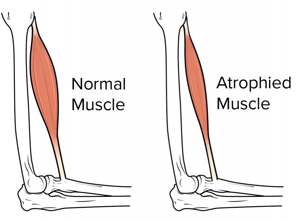 Inclusion body myositis (IBM) is a debilitating muscle disease that primarily affects individuals over the age of 40, causing progressive muscle weakness and wasting.