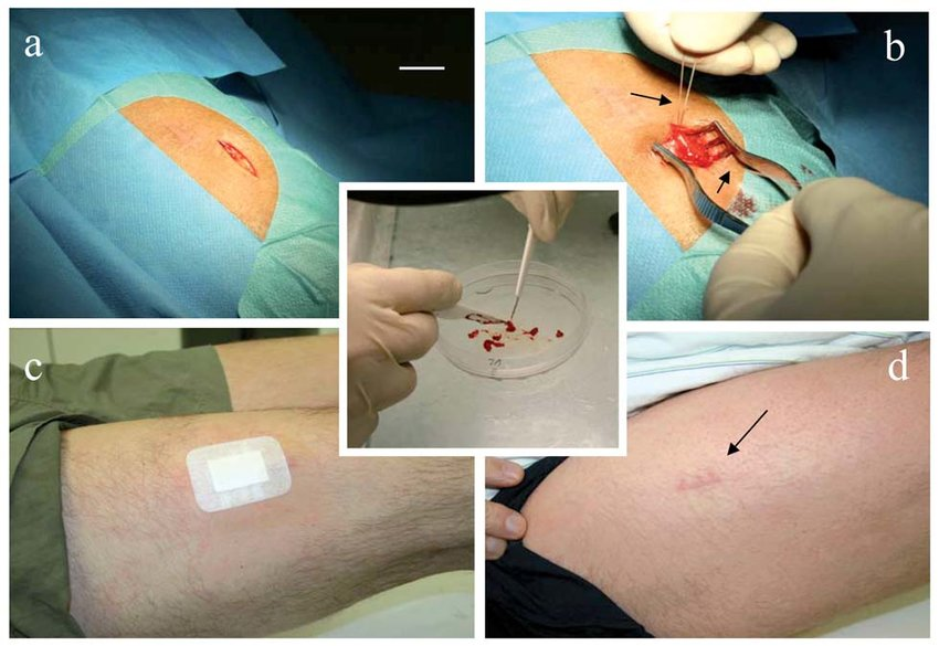 A muscle biopsy is often considered the gold standard for diagnosing IBM.