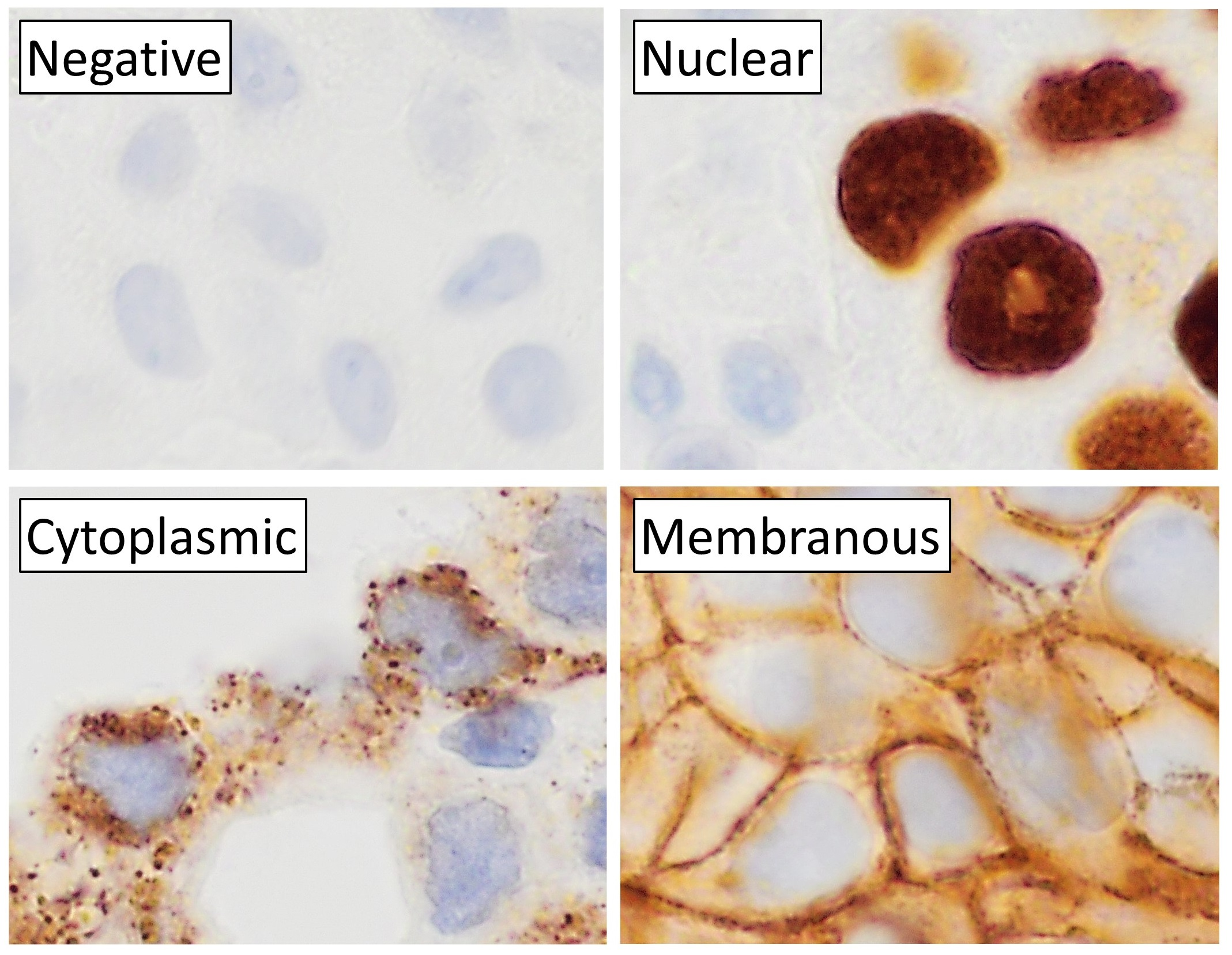 Immunohistochemical staining of muscle biopsy specimens can help identify specific proteins and markers associated with IBM pathology. 