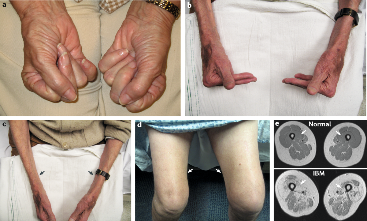 nclusion body myositis (IBM) is a chronic and progressive muscle disease that primarily affects individuals over the age of 40, leading to significant morbidity and mortality. 