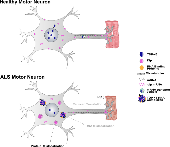 These findings align with the growing recognition of IBM as a TDP-43 proteinopathy, in which the TDP-43 protein becomes mislocalized to the cytoplasm, potentially contributing to the disease's pathogenesis 