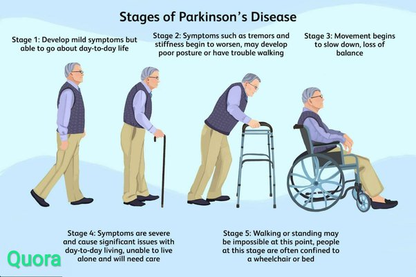 Parkinson’s Disease (PD) progresses through five distinct stages, each characterized by worsening symptoms and increasing impact on the patient’s daily life.