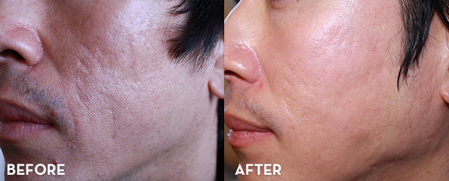 Case 4: Acne Scarring
Before Treatment: Patients with deep-pitted or atrophic acne scars suffered from uneven skin texture and pigmentation issues.

After Treatment (4–6 Months): Improvements after Cellular Therapy and Stem Cells for Dermatology and Skin Conditions at DrStemCellsThailand's Anti-Aging and Regenerative Medicine Center of Thailand  included over 50% reduction in scar depth and enhanced skin smoothness. Visible collagen remodeling resulted in increased dermal volume, and pigmentation irregularities were corrected.
