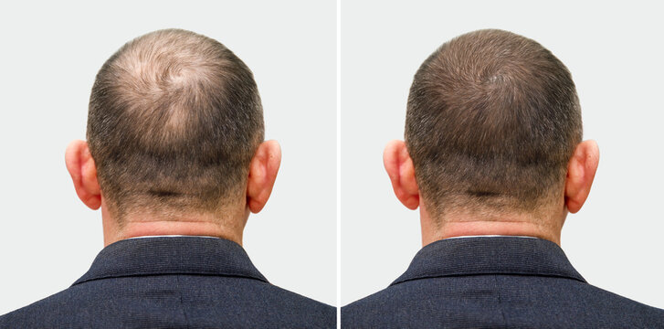 Case 5: Alopecia (Hair Loss)
Before Treatment: Patients displayed thinning hair, receding hairlines, and bald patches due to androgenetic alopecia or autoimmune alopecia areata.

After Treatment (6–12 Months): Cellular Therapy and Stem Cells for Dermatology and Skin Conditions at DrStemCellsThailand's Anti-Aging and Regenerative Medicine Center of Thailand promoted follicular regeneration, with over 60% of patients experiencing a visible increase in hair density and thickness. Dermoscopic imaging confirmed new hair follicle formation and elongation.