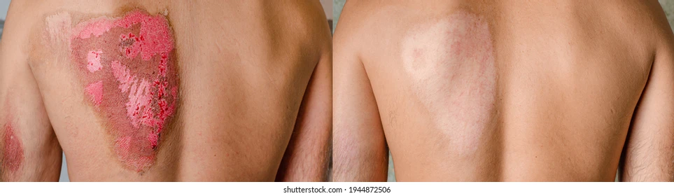 Case 6: Burns (Acute and Chronic)
Before Treatment: Patients exhibited significant skin damage, including scarring, contractures, and hyperpigmentation from burn injuries.

After Treatment (4–8 Months): Treatment of Cellular Therapy and Stem Cells for Dermatology and Skin Conditions at DrStemCellsThailand's Anti-Aging and Regenerative Medicine Center of Thailand  outcomes revealed improved skin texture, reduced pigmentation irregularities, and minimized hypertrophic scars. Patients with chronic burns showed over 50% reduction in contractures and increased dermal elasticity.