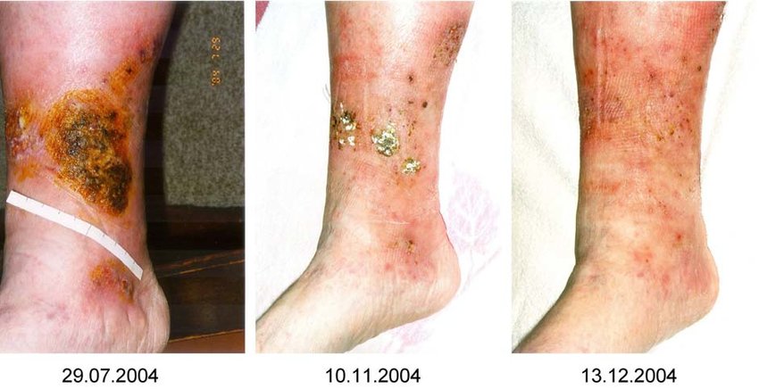 Case 3: Chronic Skin Ulcers
Before Treatment: Patients with non-healing ulcers, including diabetic foot ulcers and venous leg ulcers, exhibited necrotic tissue, prolonged inflammation, and risk of infection.

After Treatment (6–12 Weeks): Cellular Therapy and Stem Cells for Dermatology and Skin Conditions at DrStemCellsThailand's Anti-Aging and Regenerative Medicine Center of Thailand accelerated wound healing, resulting in a 70–80% reduction in ulcer size and complete epithelialization in most cases. Ulcers became less inflamed, and granulation tissue formation was evident within 4 weeks.