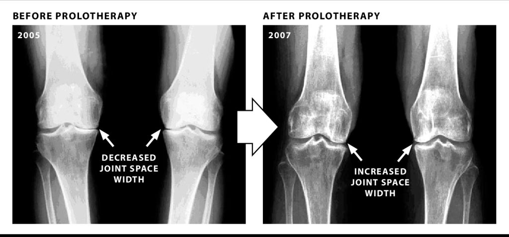 CXR and MRI scans performed 1 year after our Cellular Therapy and Stem Cells for Musculoskeletal Diseases and Orthopedic Conditions revealed a notable increase in cartilage thickness (average 1.5 mm) in the femoral condyles and tibial plateau of the knee joints in patients with chondromalacia patellae and focal cartilage defects.