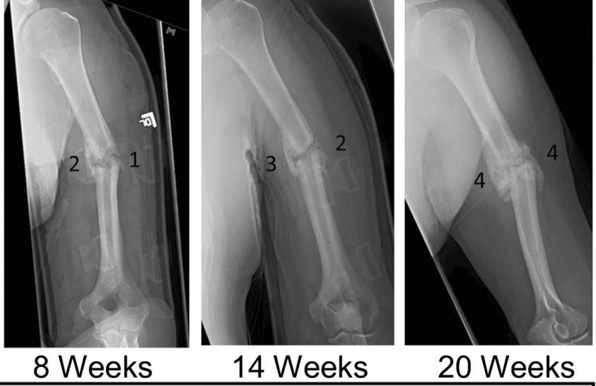 A series of Humerus X-rays showed accelerated fracture healing in 65% of patients with nonunion fractures of the humerus treated with local injection of our Cellular Therapy and Stem Cells for Musculoskeletal Diseases and Orthopedic Conditions within 4-6 months post-treatment. The healing process was confirmed by increased cortical thickness and bone bridging.