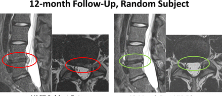 MRI scans following Cellular Therapy and Stem Cells for Musculoskeletal Diseases and Orthopedic Condition treatment at 12 months revealed disc hydration improvement (morphology) and increased disc height in 50-60% of patients with lumbar DDD. Pain scores improved by 55-65%, and functional scores (Oswestry Disability Index) were reduced by 40-50% within 1 year