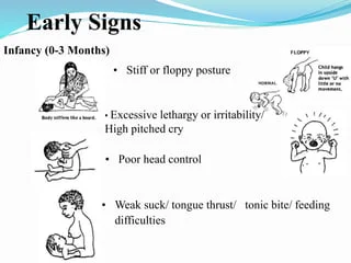 1950s: The concept of multidisciplinary care emerged, integrating physical therapy, occupational therapy, and speech therapy to address the diverse needs of Cerebral Palsy (CP) patients.