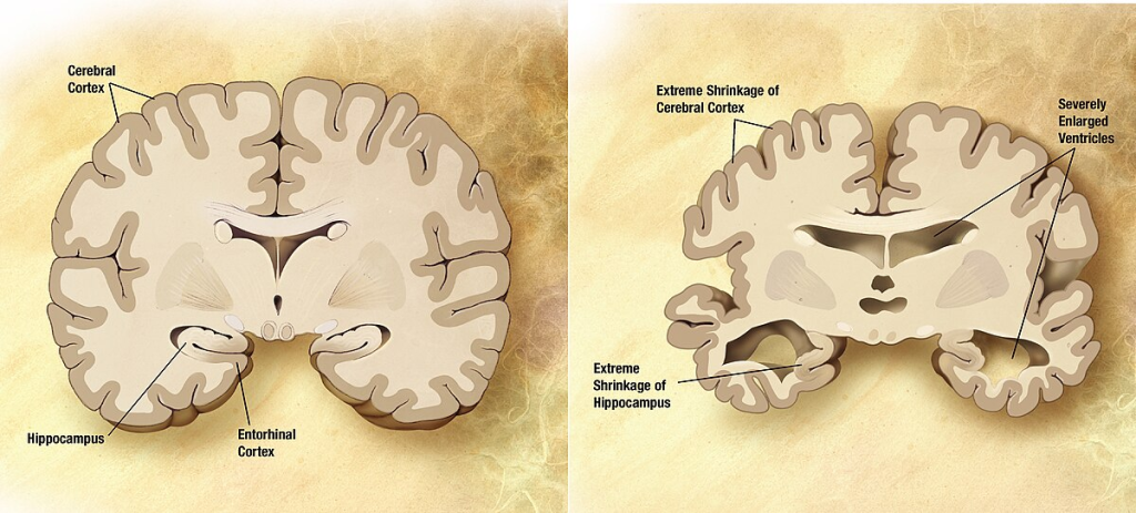 Neurodegeneration (NDG) refers to the progressive loss of structure or function of neurons, including their death. This process is often associated with various neurological disorders that can lead to significant cognitive, motor, and functional impairments. 