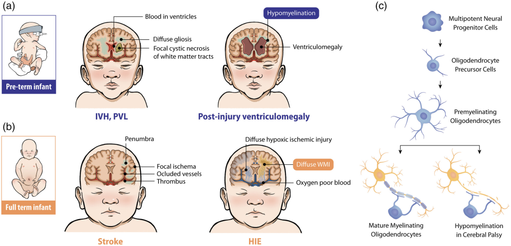 Cerebral Palsy (CP) is a multifactorial neurodevelopmental disorder arising from complex interactions between genetic predispositions and environmental influences. These factors contribute to the onset, severity, and progression of CP.