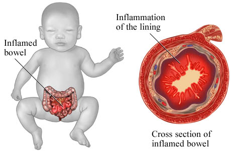 Necrotizing enterocolitis (NEC) is a severe gastrointestinal disease predominantly affecting premature infants, characterized by inflammation and necrosis of the intestinal tissue.