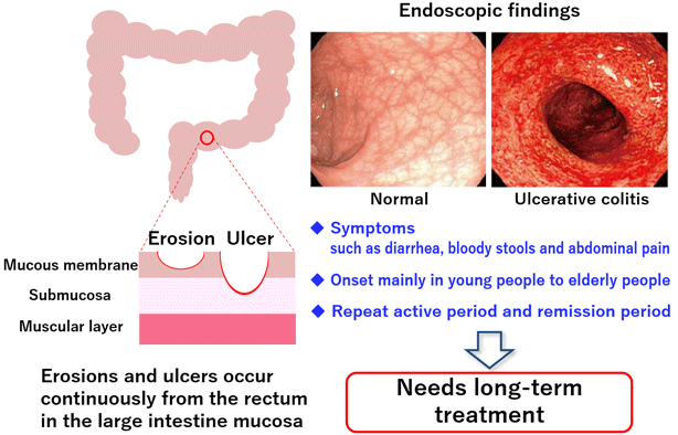 Ulcerative colitis (UC) is a chronic inflammatory disease that affects the colon's mucosal lining, primarily presenting with symptoms such as persistent diarrhea, abdominal pain, and rectal bleeding.