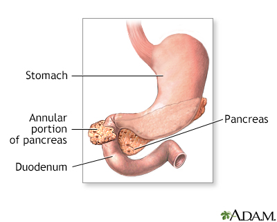 Annular Pancreas is a rare congenital condition where pancreatic tissue encircles the duodenum, potentially causing obstruction and feeding intolerance.