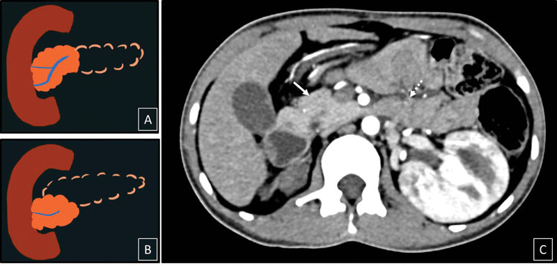 Advanced Cellular Therapy and Stem Cells for Pancreatic Diseases is investigating potential treatments to regenerate functional pancreatic tissue for these patients with Pancreatic Agenesis.