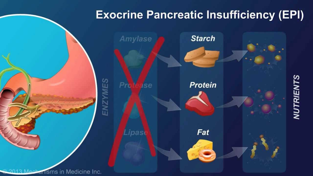 6.6 Exocrine Pancreatic Insufficiency (EPI):

EPI occurs when the pancreas fails to produce sufficient digestive enzymes, leading to malabsorption, steatorrhea, weight loss, and nutritional deficiencies.

Common causes include chronic pancreatitis, pancreatic surgery, or cystic fibrosis.

Current treatment focuses on pancreatic enzyme replacement therapy (PERT). Regenerative medicine using Cellular Therapy and Stem Cells for Pancreatic Diseases offers a promising future for restoring enzyme-producing capabilities of the pancreas.