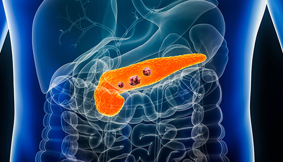 Standard treatments involve surgery, chemotherapy, and radiation. Research and clinical trials into Cellular Therapy and Stem Cells for Pancreatic Diseases aims to improve targeted delivery of drugs, modulate the tumor microenvironment, and explore potential for immune system enhancement.