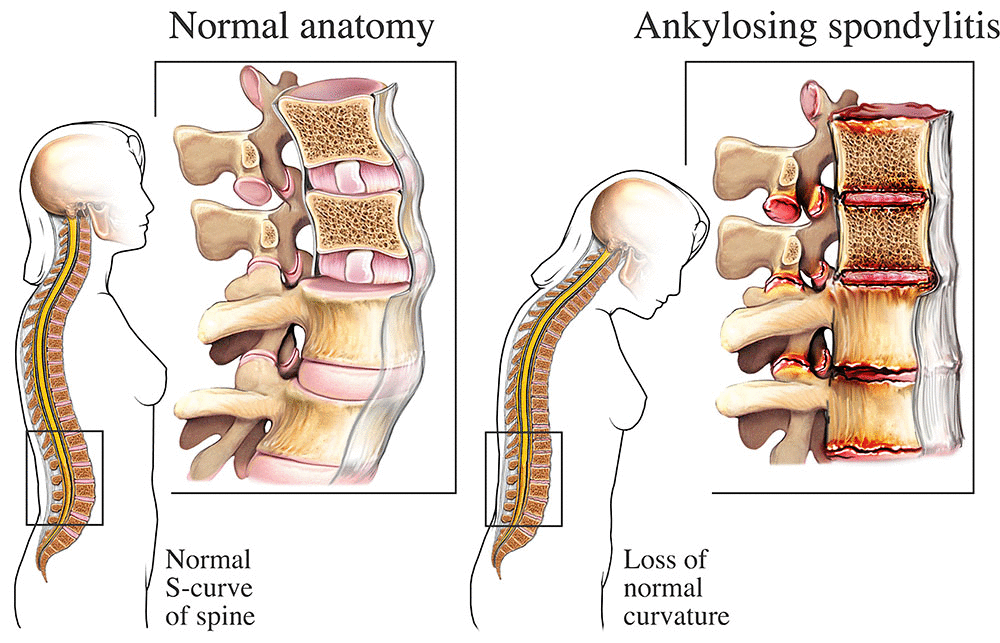 8.8 Ankylosing Spondylitis (AS)

Prevalence: Ankylosing spondylitis affects approximately 0.1%–0.5% of the global population, with higher prevalence in Caucasian and Indigenous populations.

Quality of Life: Patients experience chronic back pain, stiffness, and reduced spinal mobility, significantly impacting physical and mental well-being. Fatigue is a common symptom.

Mortality: While AS is not typically life-threatening, complications such as cardiovascular disease, spinal fractures, and respiratory issues can increase mortality risk.