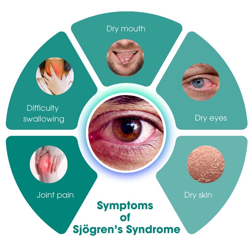 8.13 Sjögren’s syndrome

Mortality: While not typically fatal, complications such as lymphoma and organ involvement may increase mortality risk.

Prevalence: Sjögren’s syndrome affects approximately 0.1%–4% of the population, with a marked female predominance.

Quality of Life: Symptoms include dry eyes and mouth, fatigue, and joint pain, profoundly impacting both physical and emotional well-being. Secondary Sjögren’s can coexist with other autoimmune diseases.