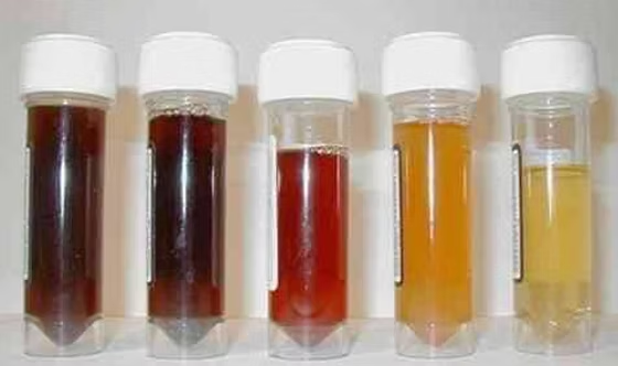 Hematuria is the presence of blood in the urine, which can be gross (visible to the naked eye) or microscopic (detected only through laboratory testing). It can occur due to various underlying conditions, ranging from benign to serious.