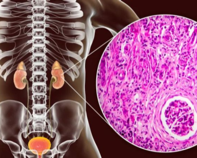 Renal fibrosis is a pathological condition characterized by the excessive accumulation of extracellular matrix (ECM) components in the kidneys, leading to scarring and progressive loss of renal function. This condition often results from chronic kidney diseases (CKD), including diabetic nephropathy, hypertension, and glomerulonephritis. The progression of renal fibrosis can severely impair kidney function, ultimately leading to end-stage renal disease (ESRD).