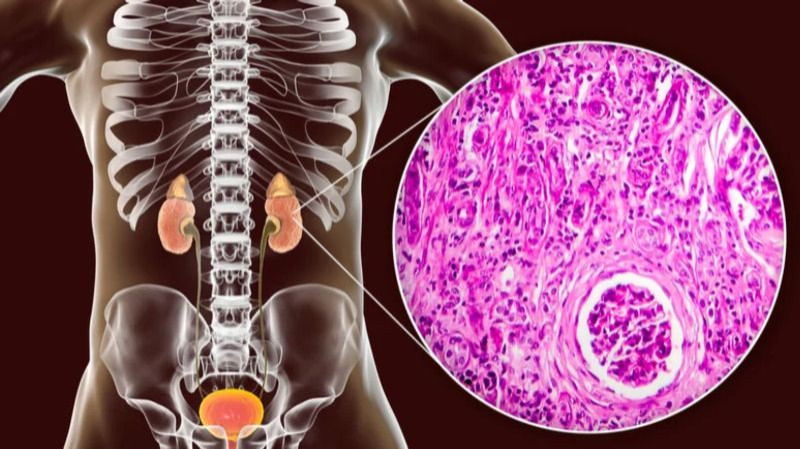 Renal fibrosis is a pathological condition characterized by the excessive accumulation of extracellular matrix (ECM) components in the kidneys, leading to scarring and progressive loss of renal function. This condition often results from chronic kidney diseases (CKD), including diabetic nephropathy, hypertension, and glomerulonephritis. The progression of renal fibrosis can severely impair kidney function, ultimately leading to end-stage renal disease (ESRD).