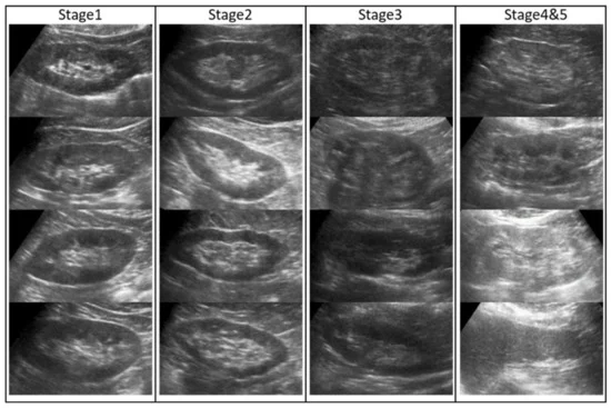 InsertingHere is another kidney ultrasound picture illustrating improvement 1-year post treatment of Cellular Therapy and Stem Cells for Kidneys and Renal Diseases with Renal Progenitor Stem Cells showing a change of CKD stage from CKD stage 3 to 2 and CKD stage 4 to 3 respectively.image... 1