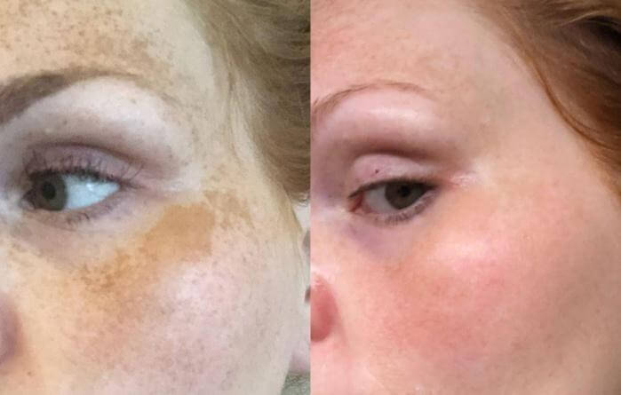 Case 7: Hyperpigmentation (Melasma)
Before Treatment: Patients presented with dark, irregular patches of pigmentation on the face and neck, often resistant to topical therapies.

After Treatment (3–6 Months): Observations after Cellular Therapy and Stem Cells for Dermatology and Skin Conditions at DrStemCellsThailand's Anti-Aging and Regenerative Medicine Center of Thailand   indicated a 50–70% reduction in pigmentation intensity, enhanced skin tone uniformity, and collagen regeneration, resulting in brighter and healthier skin.